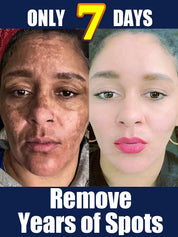 Hot Sale Cleaning Melasma Tools